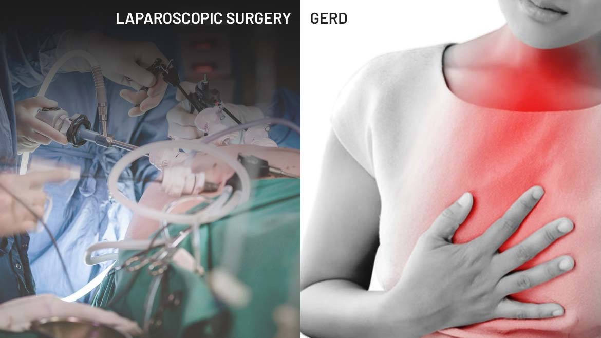 Laparoscopic surgery for GERD