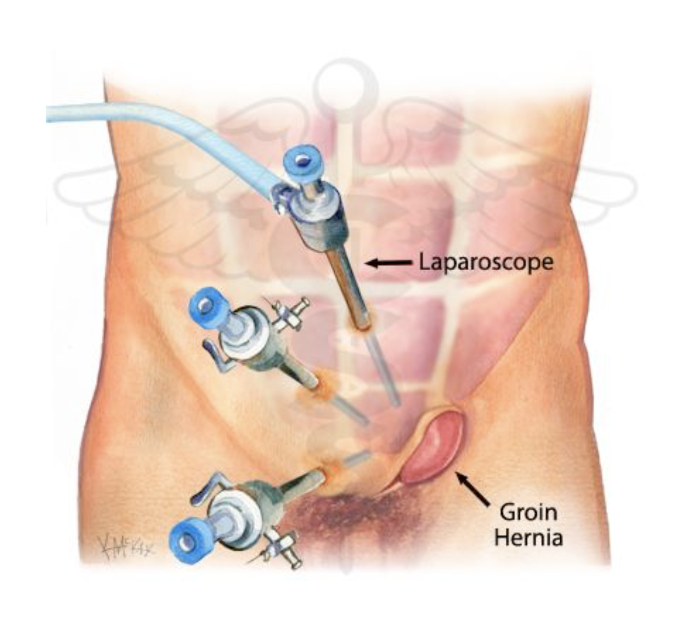 Which is a better option for Inguinal hernia: Open or Laparoscopic surgery?