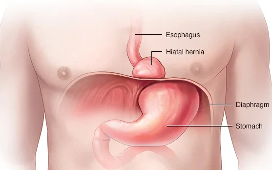 hiatus hernia surgery